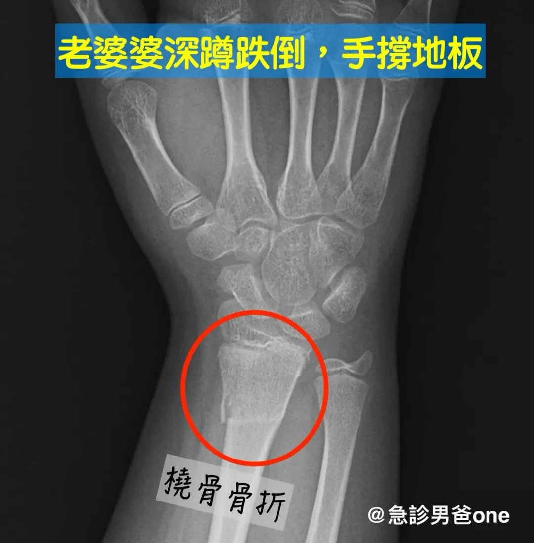 婆婆看到女兒在做深蹲，就硬要跟著做，結果一不小心就跌倒了。（圖／翻攝自臉書《急診男爸one》）