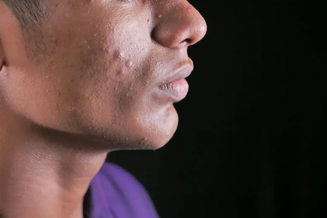 50歲男子連吃三天藥膳羊肉爐，脖子跟頭皮長滿痘痘，就醫治療忍不住自嘲「重返青春期回春」了！（示意圖／非當事人／pexels）