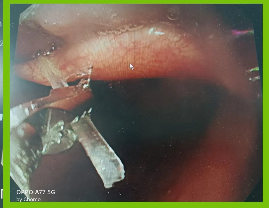 若真的不幸魚刺卡在喉嚨，唯一解法是盡速送醫。（圖／黑倫醫師x健康諮詢）