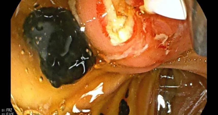 一位百歲阿嬤有高血壓、急性膽囊炎及結石。（圖／翻攝自新泰綜合醫院臉書）