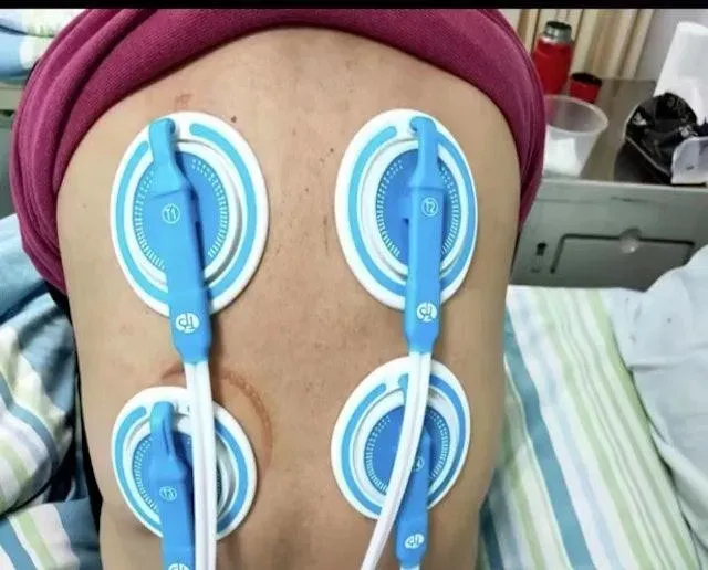醫療團隊從王先生的肺部洗出17升「牛奶」樣的脂蛋白樣物質。（微信公眾號@西安市胸科醫院）