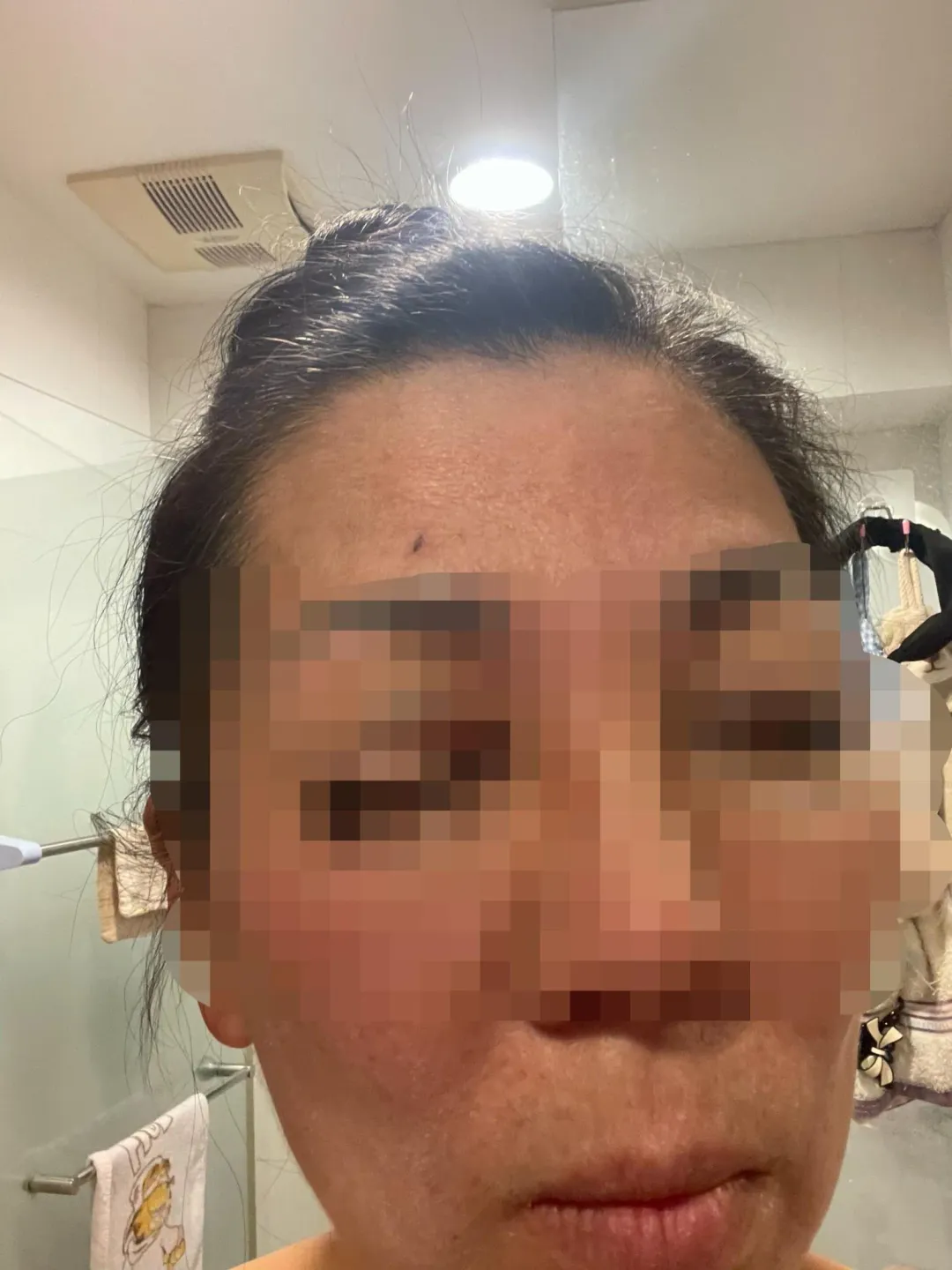徐女右眼嚴重瘀青。(圖/中天新聞)