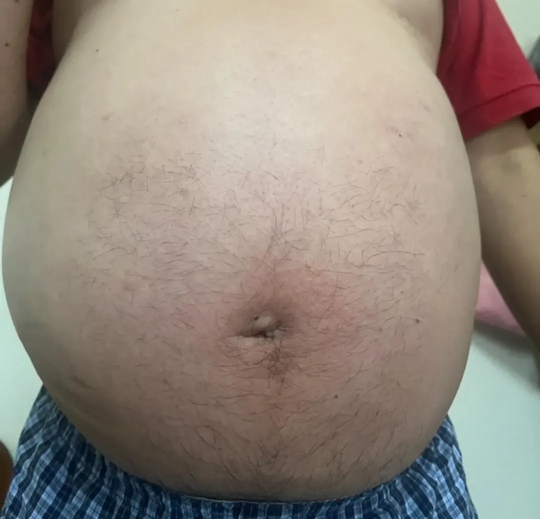 患者自述8年前發現有高血壓,年初發現肚子愈來愈大,遭太太取笑像懷三胞胎。(圖/員榮醫院提供)
