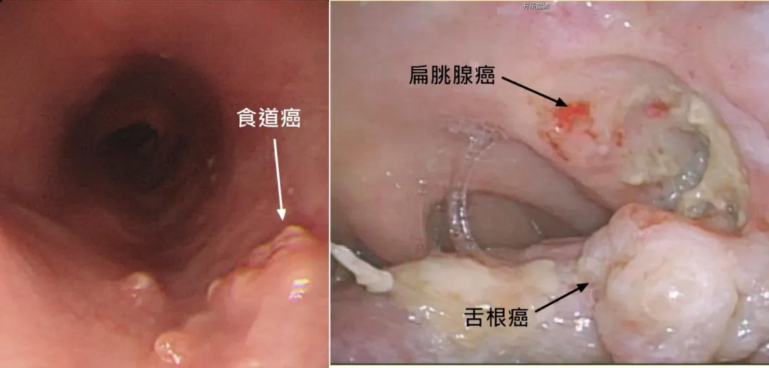 食道癌與口腔癌,大多是可以預防的。(圖/臺北市立聯合醫院提供)