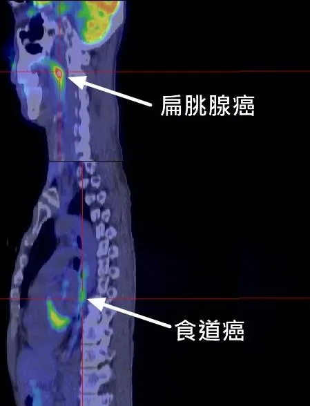 食道鱗狀上皮細胞癌常和其他上呼吸消化道鱗狀上皮細胞癌同時發生。(圖/臺北市立聯合醫院提供)