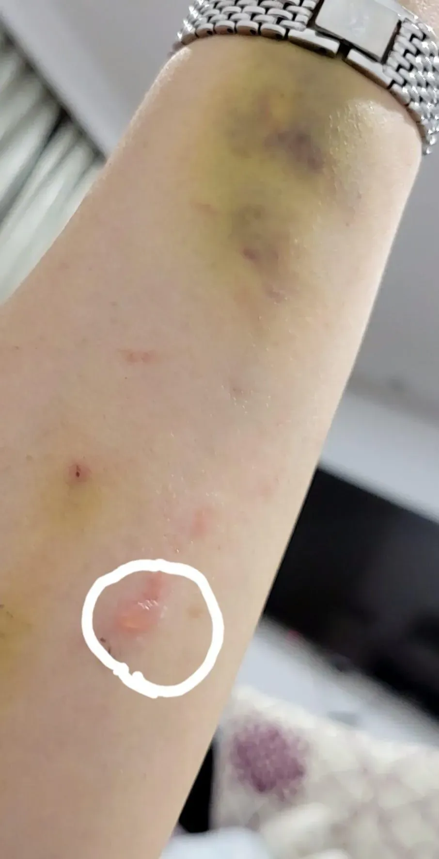 小彤化療後皮膚變得敏感脆弱，只要輕輕一碰就會瘀青，隨手一抓就破皮，甚至起了水泡。（圖／兩性作家小彤 ）