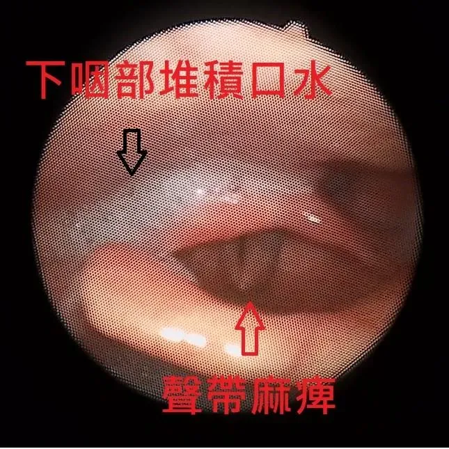 阿博卡痰一年多就醫檢查驚見「聲帶已經幾乎不太會動」。（圖／【陳亮宇醫師 / 陳亮宇耳鼻喉科診所】臉書粉專）
