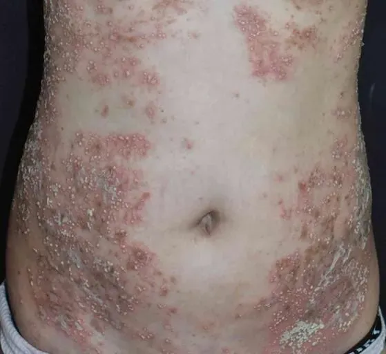 假設感染新冠病毒會使5成的乾癬患者病況惡化,而疫苗的惡化機率是3成。(圖/維基百科)