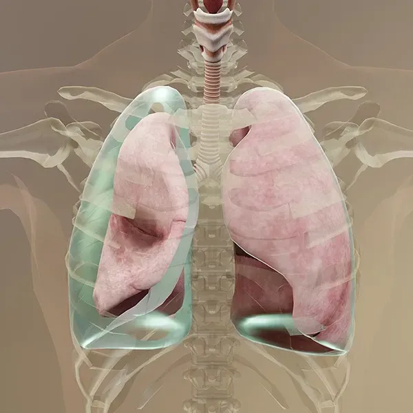 異位性子宮內膜組織剝落後可能經由腹腔移動至橫隔膜,造成橫膈膜甚至肋膜出現異位性子宮內膜。(示意圖/資料庫)