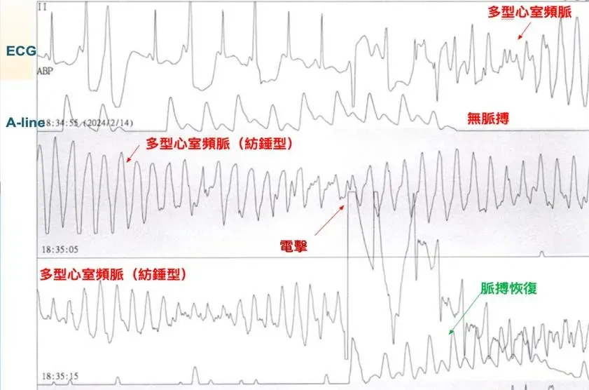 小涵因抽搐時間過長且未自行甦醒被緊急送醫，每次電擊後不到5分鐘又再次發作，長達40分鐘。（圖／中國醫藥大學附設醫院提供）