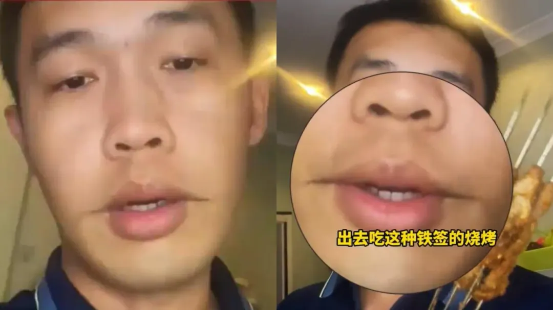 吉林男子吃燒烤被燙出「微笑唇」(圖/翻攝微博)