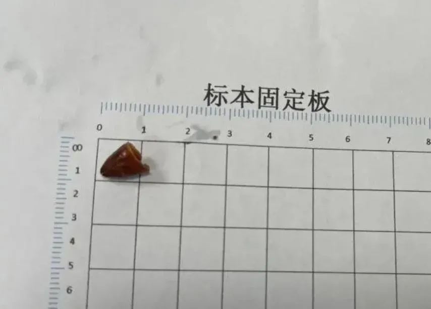 開刀取出一節辣椒。（圖／翻攝微博）