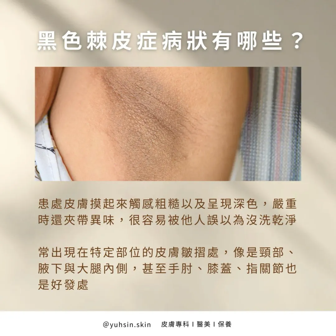 黑色棘皮症的患處皮膚,摸起來觸感粗糙,且呈現深色,嚴重時還會夾帶異味,容易被他人誤以為是洗澡沒洗乾淨。(圖/翻攝自【皮膚專科 王佑鑫醫師】臉書粉專)