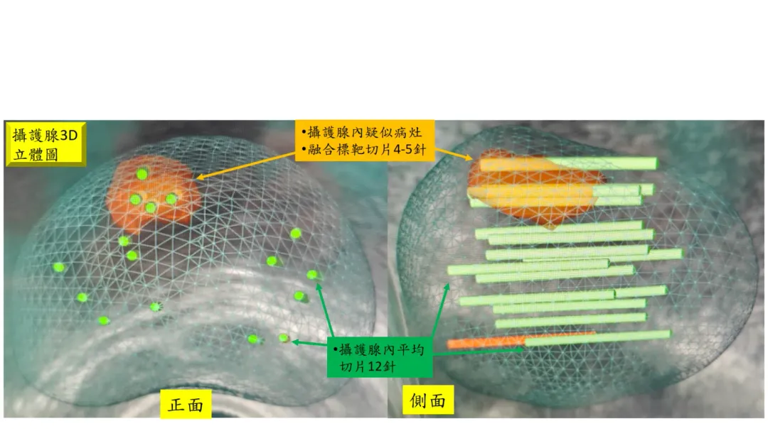 對於初步PSA異常患者，推薦優先進行磁振造影（mpMRI）檢查當要不要切片的第二參考意見。（圖／桃園醫院提供）