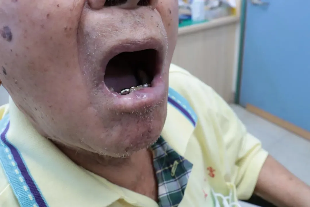阿公左下唇手術重建後,外觀如常。(圖/彰化醫院提供)