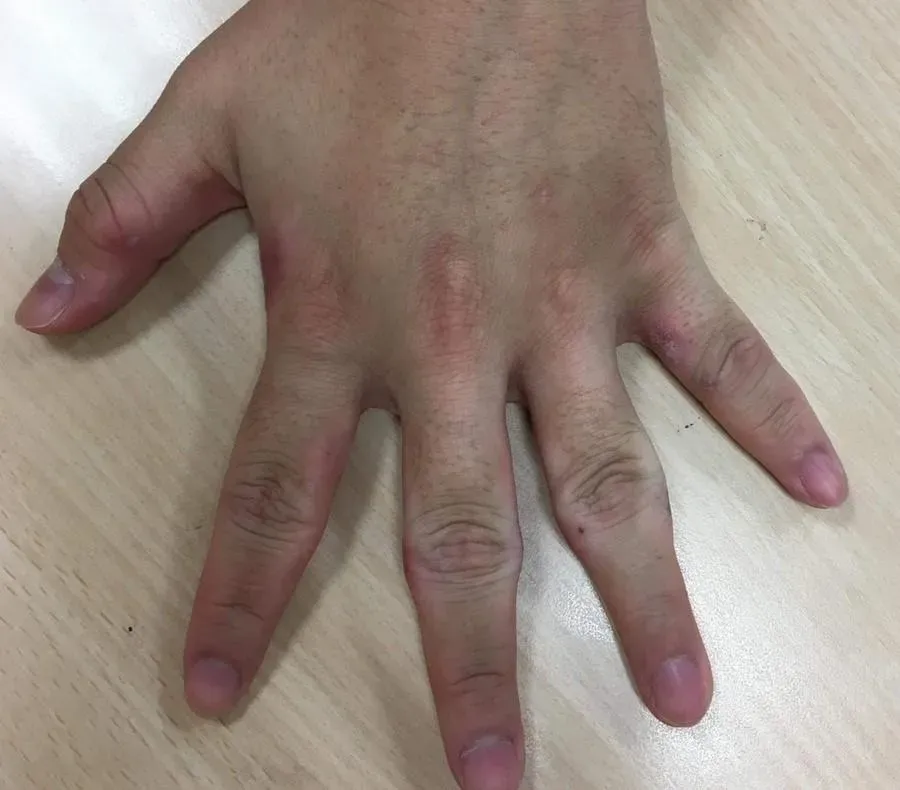 治療四個月腫脹已有明顯減少，目前仍在治療中。（圖／台北慈濟醫院提供）
