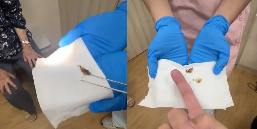 從伯伯兩耳清出很大的耳垢，至少都接近3公分長。（圖／張益豪醫師/耳鼻喉專科免疫與營養學.嗅覺味覺五官大使白袍人生學院）