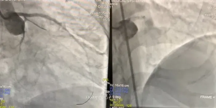 患者到院後醫師進行心導管檢查，發現左冠狀動脈完全阻塞（左）、經緊急裝置心臟支架，成功打通左冠狀動脈血流（右）。（圖／台中醫院提供）