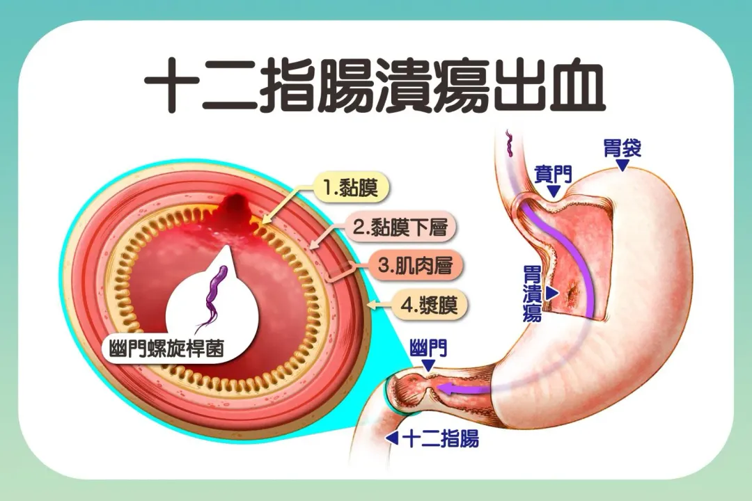 幽門螺旋桿菌經由糞、口傳播，能生存在酸性環境引發黏膜發炎、潰瘍，進而導致癌症。（圖／台中慈濟醫院提供）