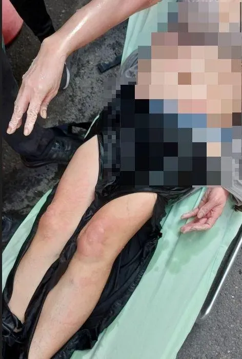 61歲林姓婦人全身有25%二度燒燙傷。(圖／翻攝畫面)
