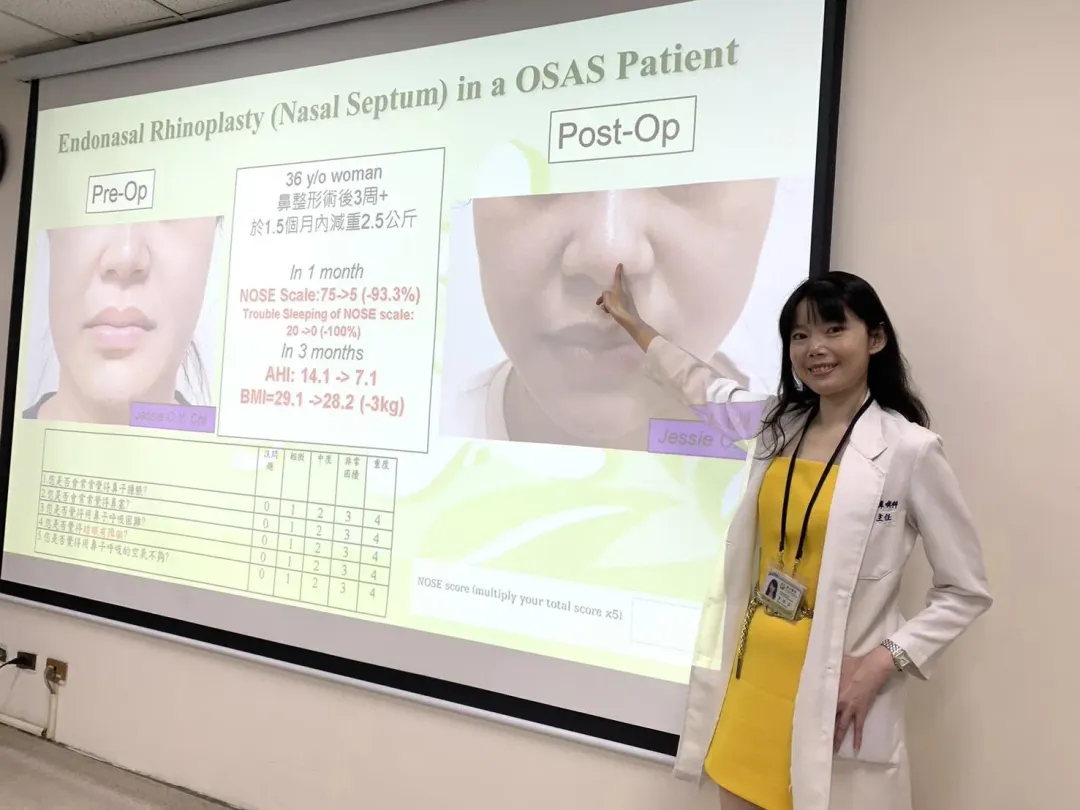 衛生福利部臺中醫院耳鼻喉科主任季照芸說明「功能性暨美觀性鼻整形手術」術後立即照。個案治療前(左)後(右)。(圖/台中醫院提供)
