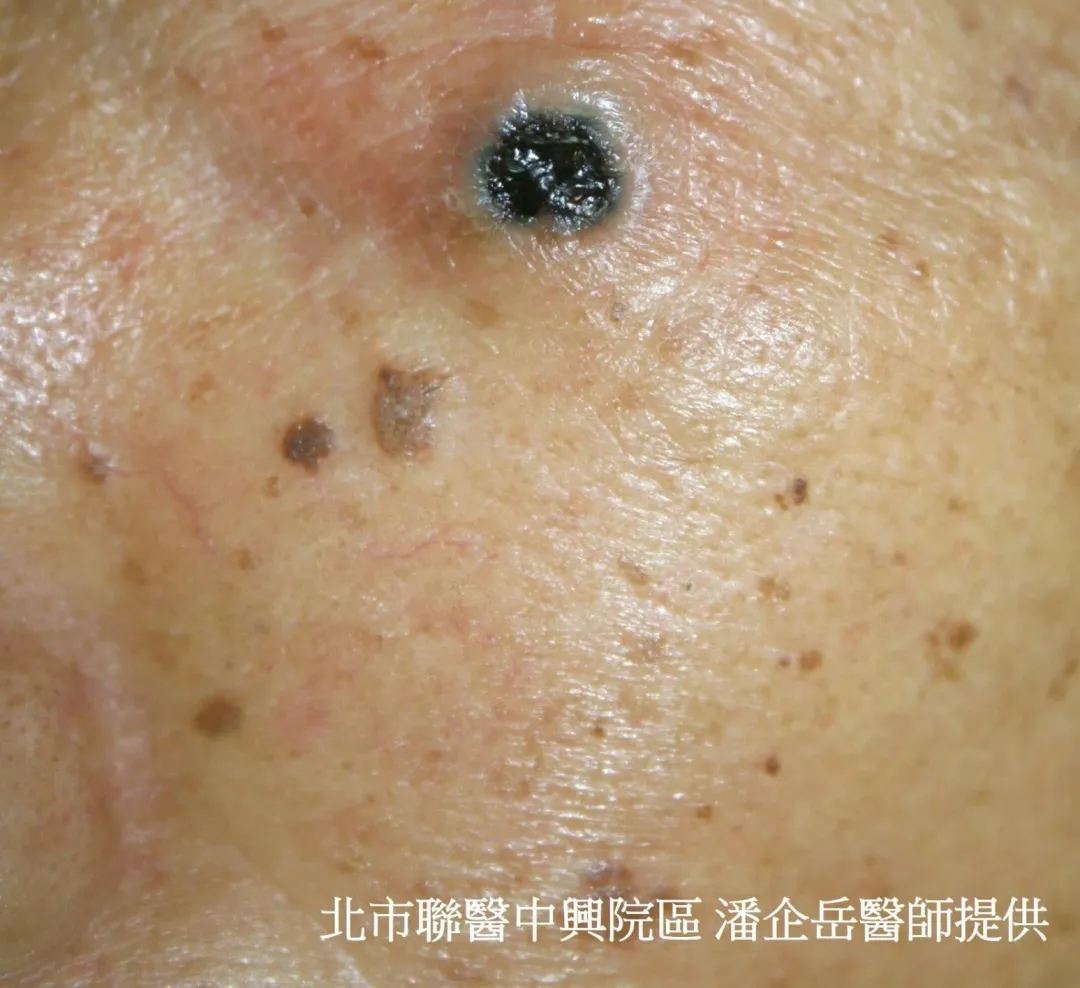皮膚基底細胞癌。（圖／皮膚科主任潘企岳提供）
