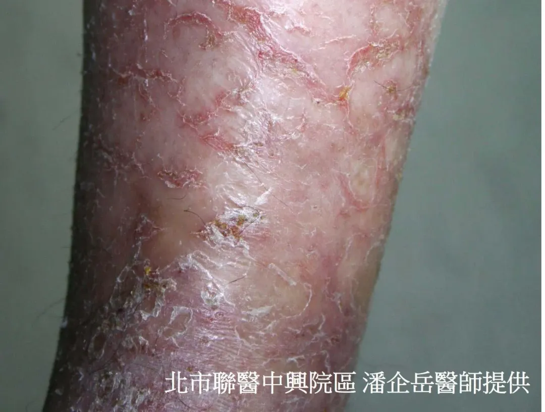 缺脂性皮膚炎。（圖／皮膚科主任潘企岳提供）
