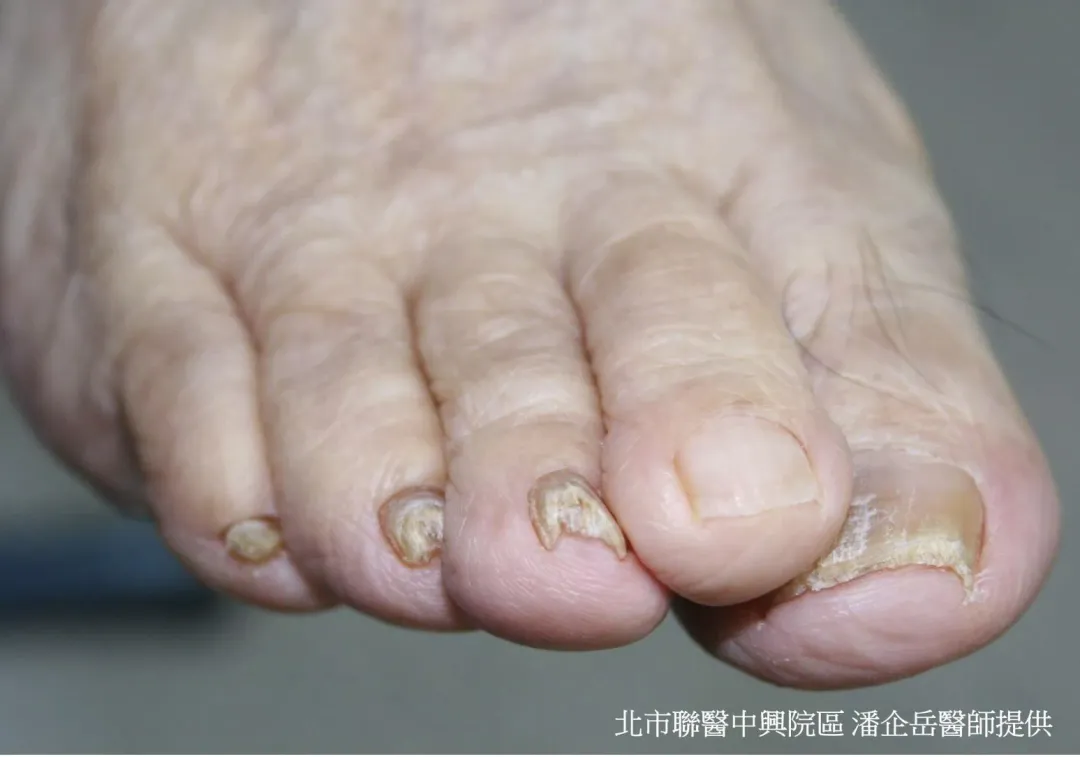 灰趾甲。（圖／皮膚科主任潘企岳提供）