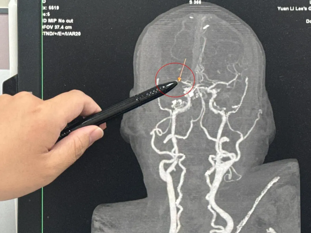 患者右腦梗塞性中風,造成左半身癱瘓。(圖/大甲李綜合醫院提供)