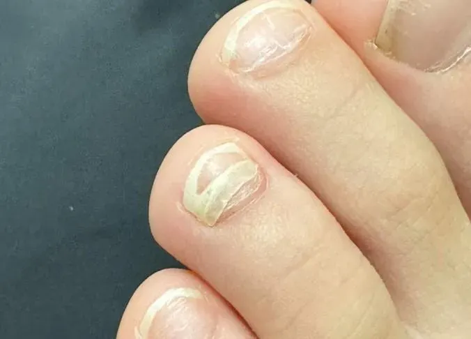 得了腸病毒,有可能一兩個月之後會掉指甲!(圖/翻攝自臉書「柚子醫師的育兒診療室 - Dr.陳木榮醫師」)