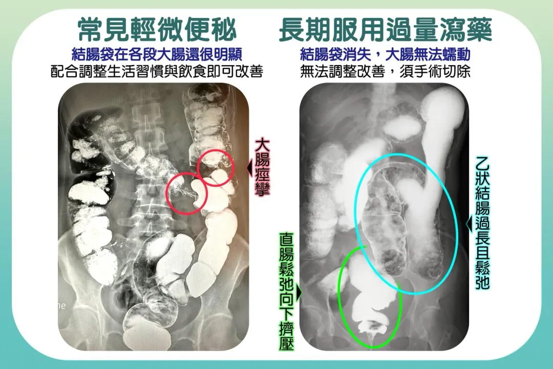 左圖顯示輕微便秘的腸道狀況，大腸蠕動正常，調整生活習慣及飲食即可改善；右圖為長期過量服用瀉藥的腸道變化，結腸袋消失，無法蠕動，須靠手術解決。（圖／台中慈濟醫院）