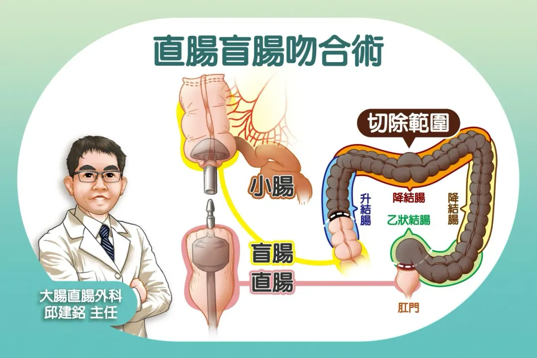 邱建銘主任為病人切除已失去功能的大腸，並將盲腸與直腸吻合，以預防術後過度腹瀉或夜間滲便。（圖／台中慈濟醫院）