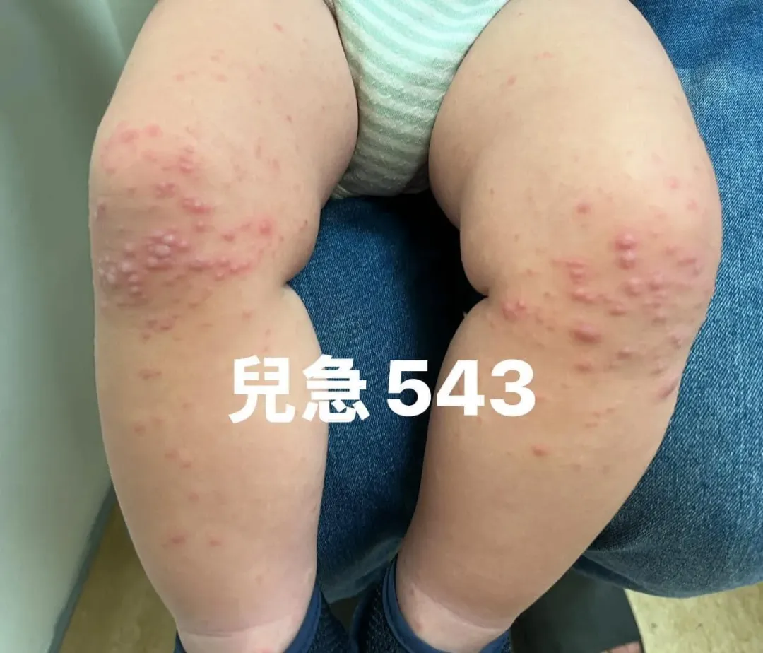 兒科急診醫師表示,近期兒科急診感染腸病毒的患者確實有增加,且病童的皮膚疹症狀都很嚴重。(圖/翻攝自「來講兒科急診的543-吳昌騰醫師」)