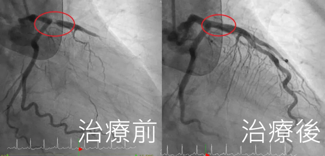患者打通血管治療前及治療後。（圖／亞洲大學附屬醫院提供）