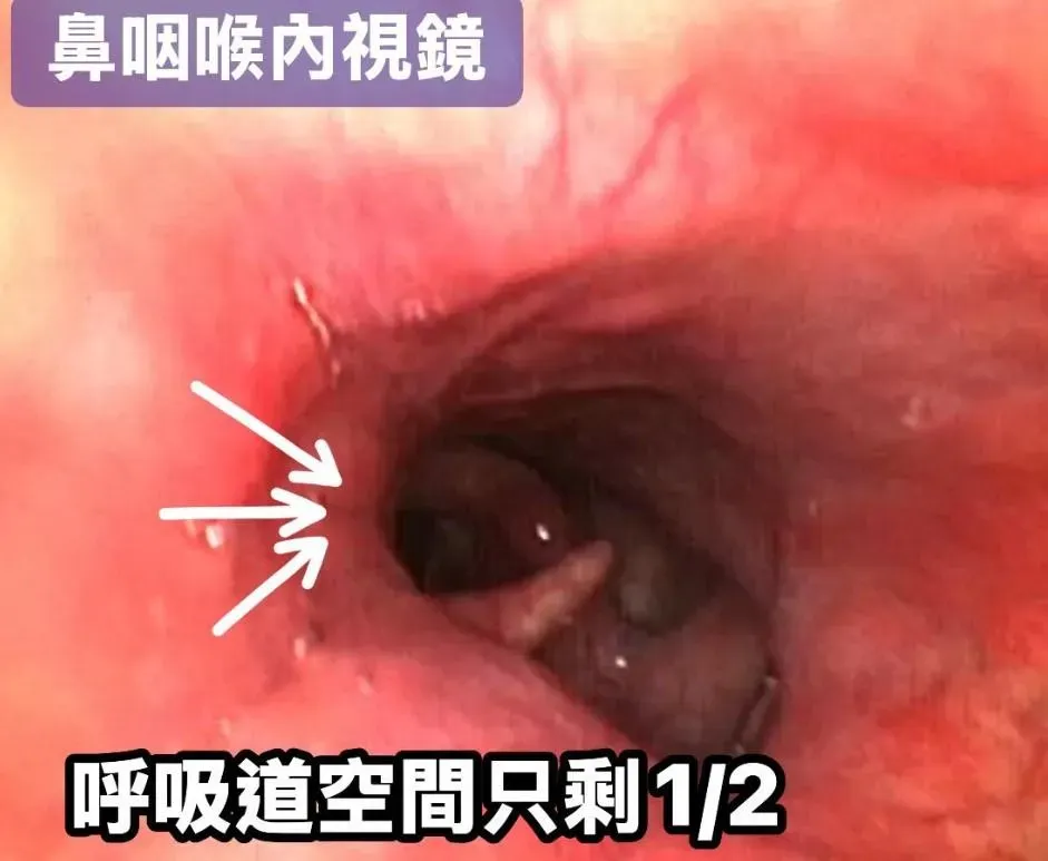 當下以內視鏡檢查患者的咽喉部，卻驚見其側咽壁都已腫起來，呼吸道被壓迫到只剩一半。（圖／翻攝自「李典憲 耳鼻喉科醫師」）