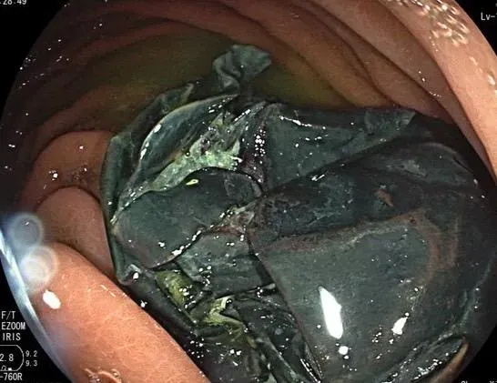 南投一名約40歲男子誤食矽膠手套卡在腸道，導致腹脹、頻繁嘔吐，經手術才順利取出。（圖／衛福部南投醫院提供）