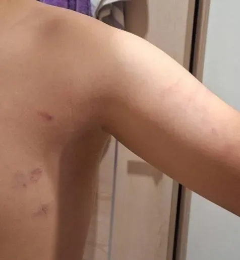 畫面中可見,孩子手臂、肩膀出現傷痕,還因內褲露出被同學訕笑,至今不敢穿短褲。(圖/翻攝畫面)