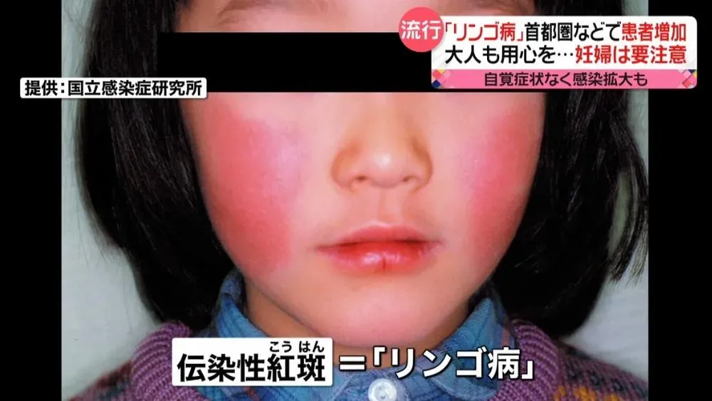 俗稱「蘋果病」的傳染性紅斑會造成雙頰通紅。(圖/翻攝NNN)