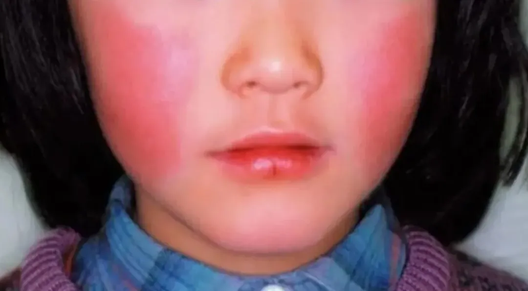 傳染性紅斑症（erythema infectiosum）是由微小病毒B19所引起，傳染途徑是由飛沫傳染。（圖／翻攝日本國立傳染病研究所）