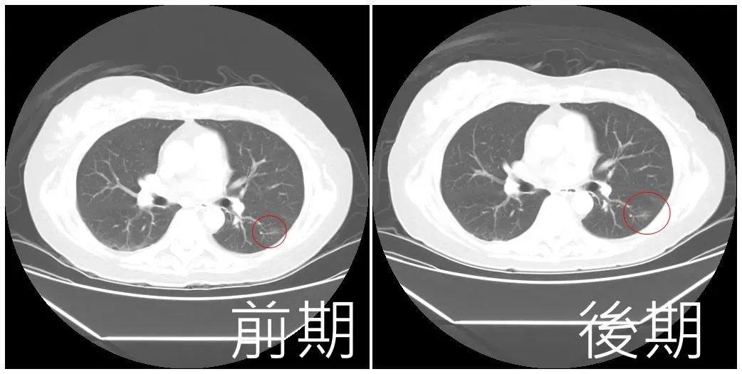 71歲阿嬤兩年前發現一顆0.8公分肺結節，拖今年才回診，結果肺結節長大一倍。（圖／亞大醫院提供）