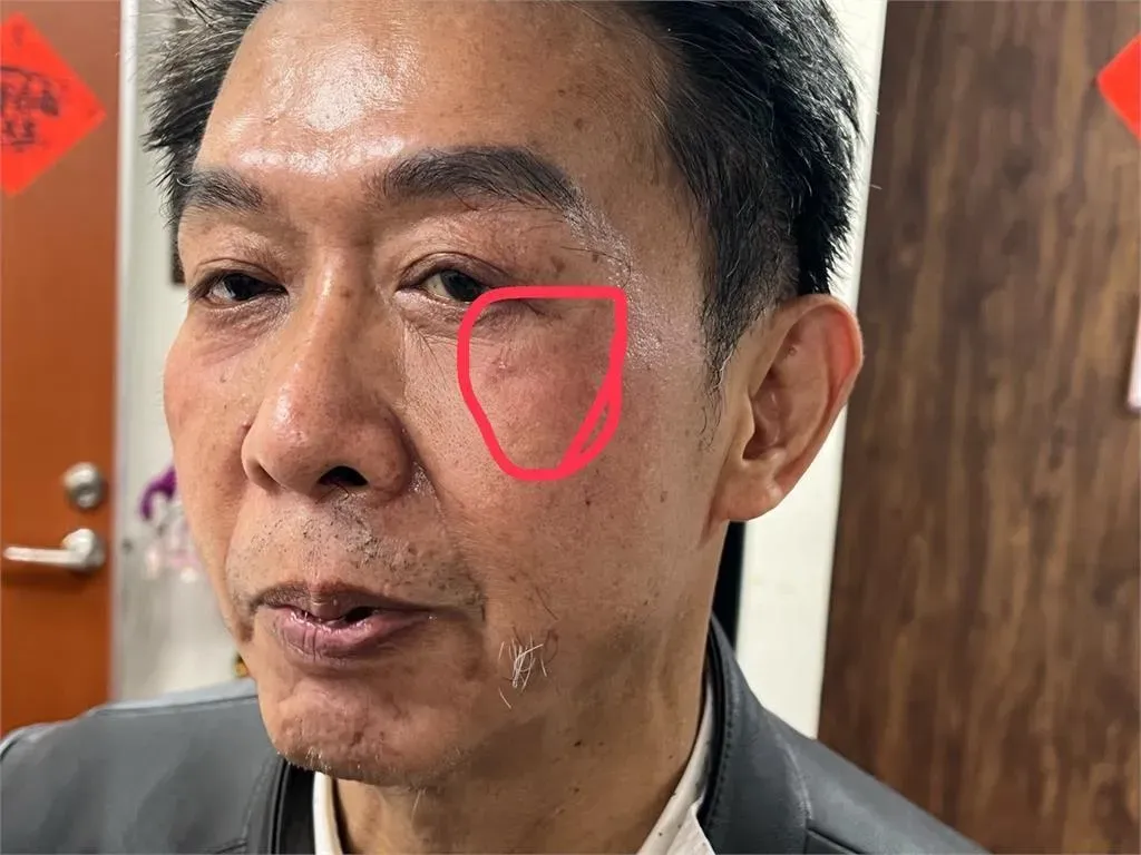 許智傑左臉眼瞼下方紅腫挫傷。（圖／許智傑辦公室提供）