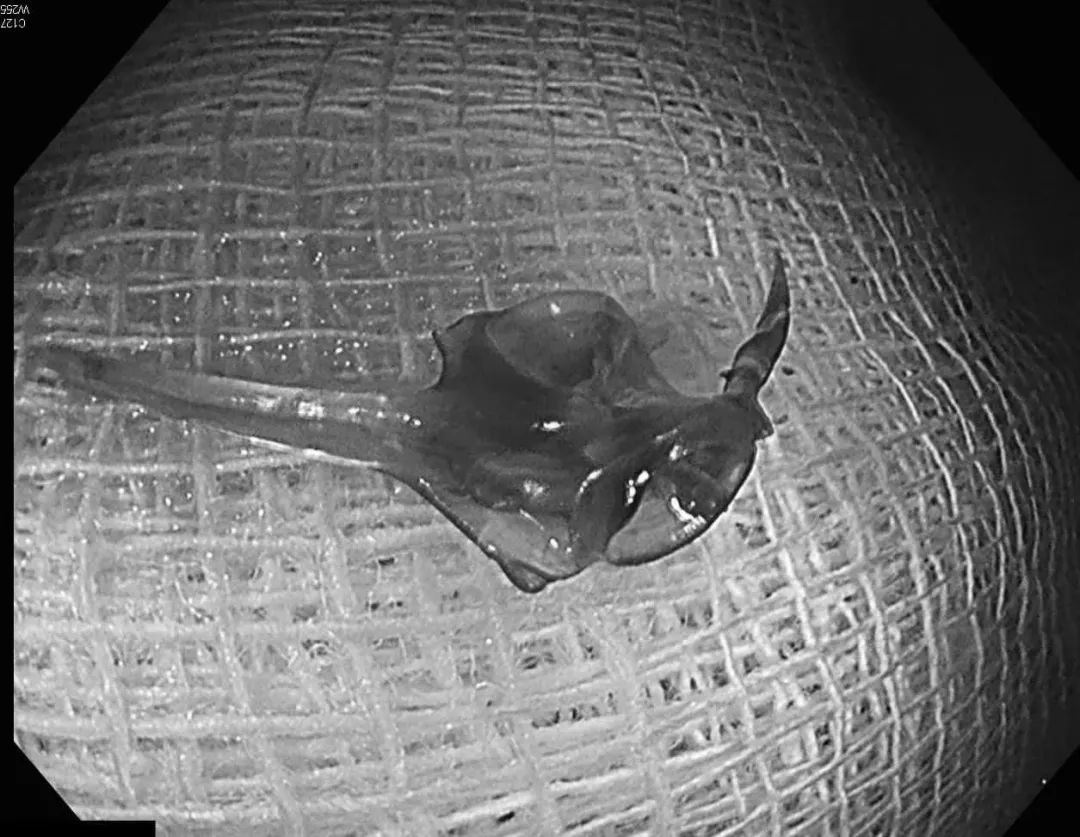 一位8旬老翁大腸裡同時充滿黑便和鮮血，原因竟是喝土魠魚湯時誤吞魚刺。（圖／翻攝自臉書「錢政弘 胃腸肝膽科醫師」）