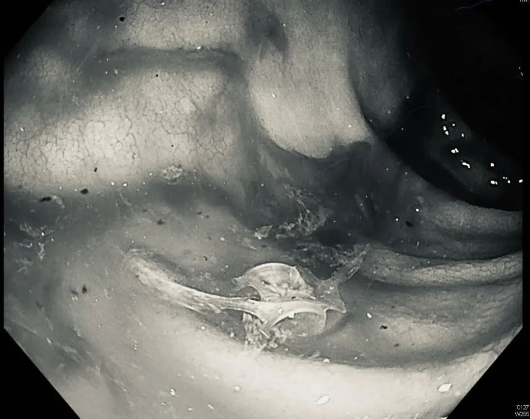 一位8旬老翁大腸裡同時充滿黑便和鮮血，原因竟是喝土魠魚湯時誤吞魚刺。（圖／翻攝自臉書「錢政弘 胃腸肝膽科醫師」）