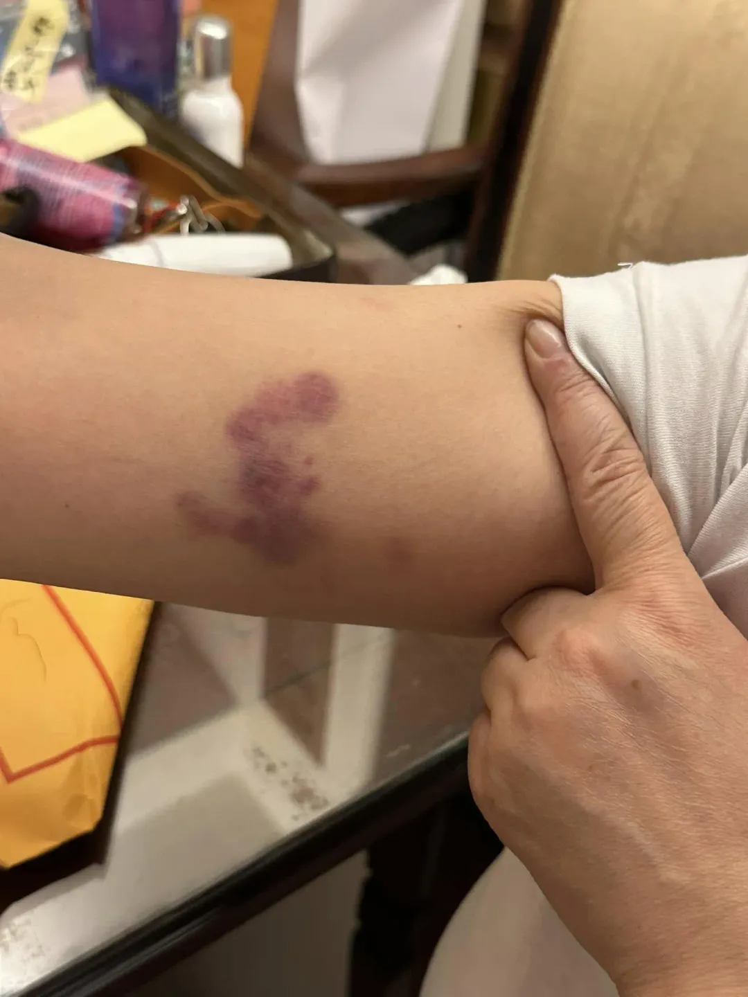 國民黨立委陳玉珍深夜返家出示自己傷勢累累。（圖／取自陳玉珍臉書）