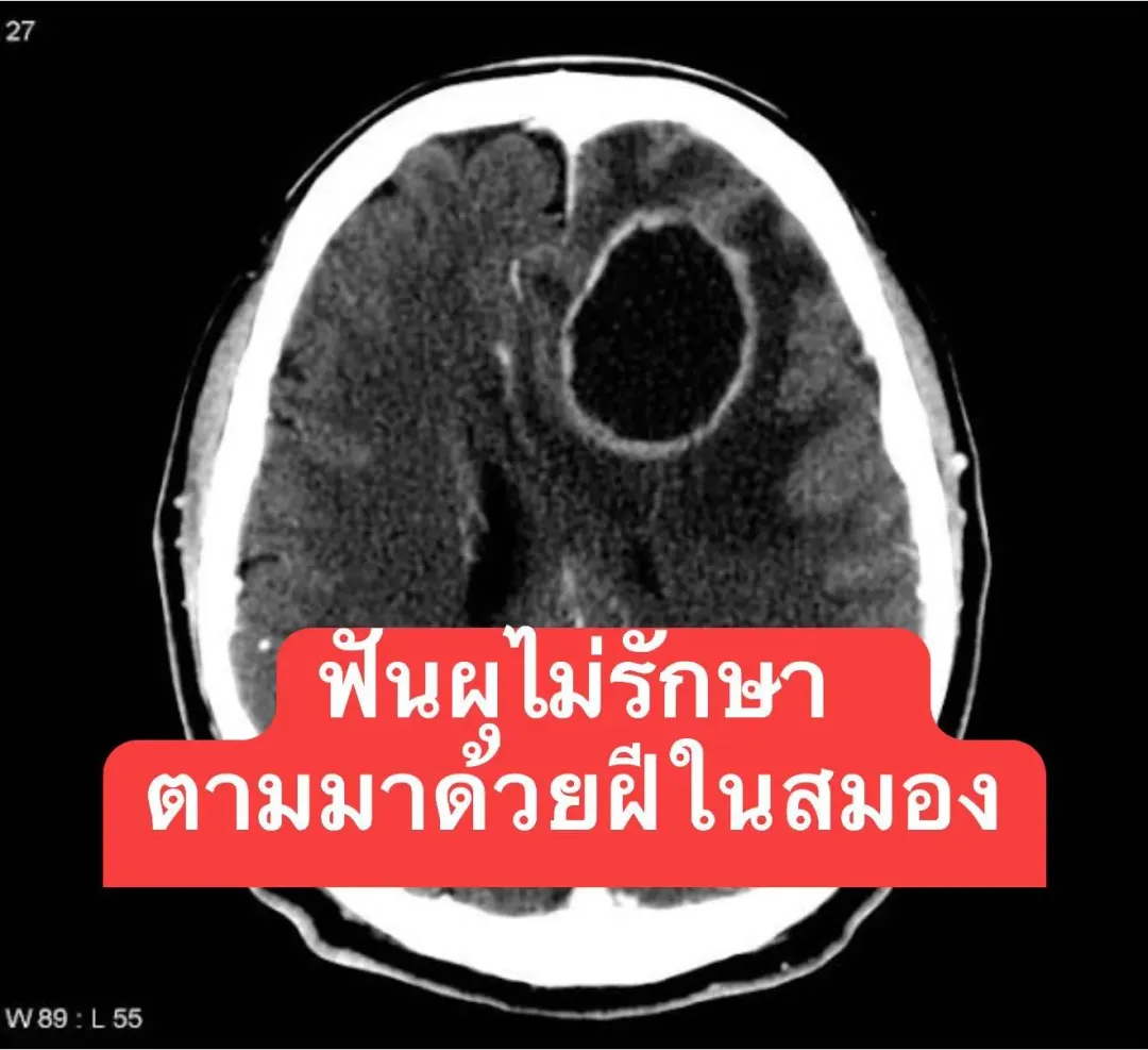 老婦因為滿口蛀牙,導致細菌感染,最終細菌入侵腦部,形成腦膿瘍。 (圖/翻攝臉書「สาระสมองกับ อจ.หมอสุรัตน์」)