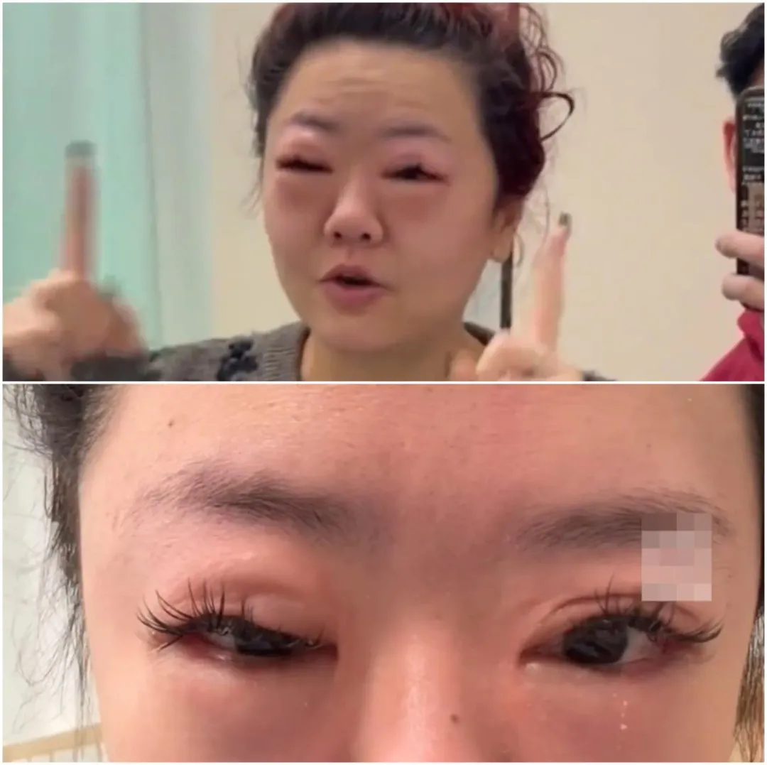 廣東女子因吃過量櫻桃導致雙眼腫脹。（圖／翻攝微博）