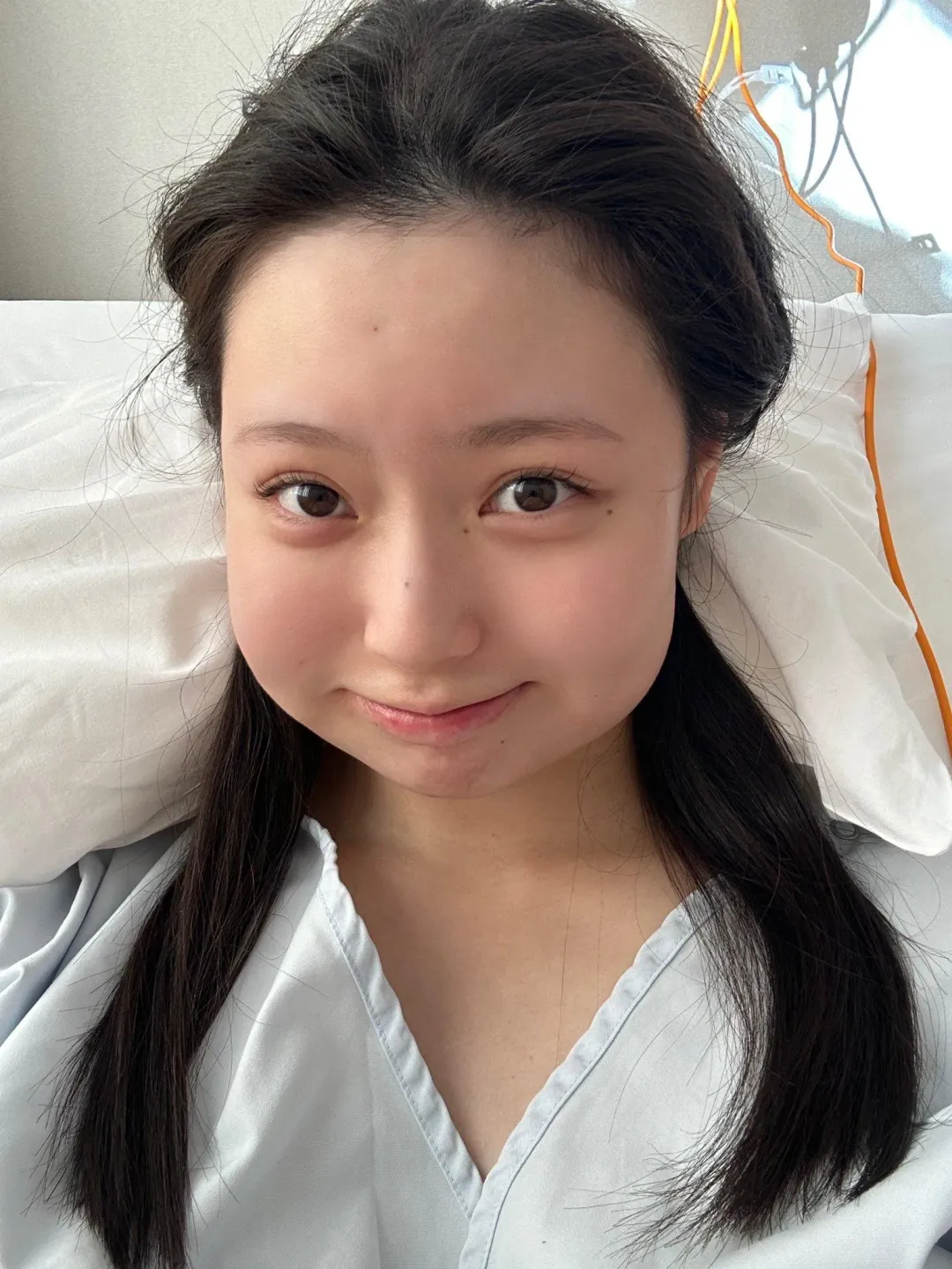 安井南拔完牙齒，臉頰腫起來。（圖／翻攝自社群平台X）