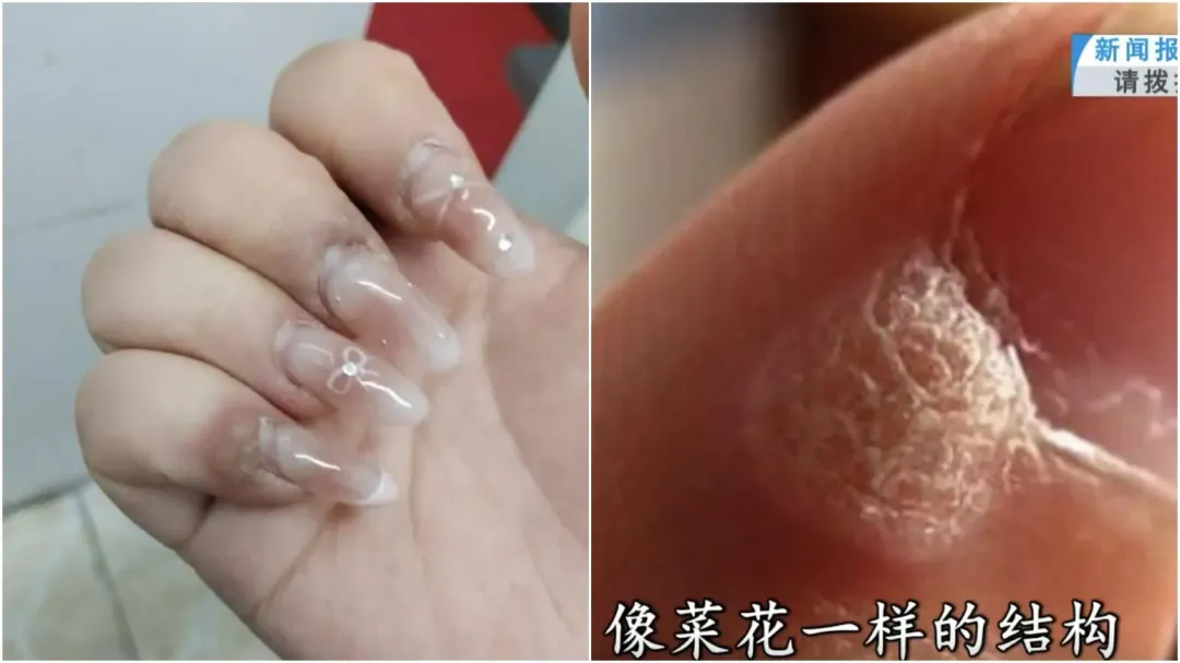 大陸有多名常做美甲的女子長了菜花狀的病毒疣。（圖／翻攝微博）