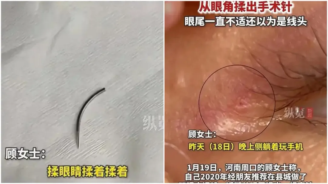 大陸一名女子從眼睛裡揉出細長彎針。（圖／翻攝微博）