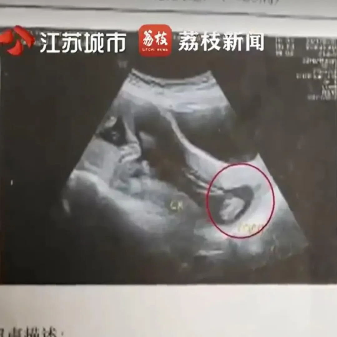 超音波顯示當時胎兒一腳踹出母親的子宮。（圖／翻攝微博）